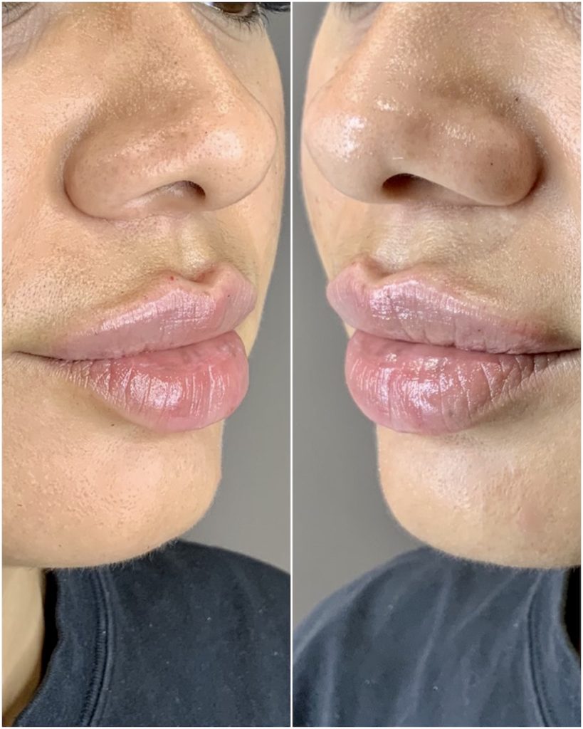 Russian Lip Filler Russian Technique Lips in Sydney