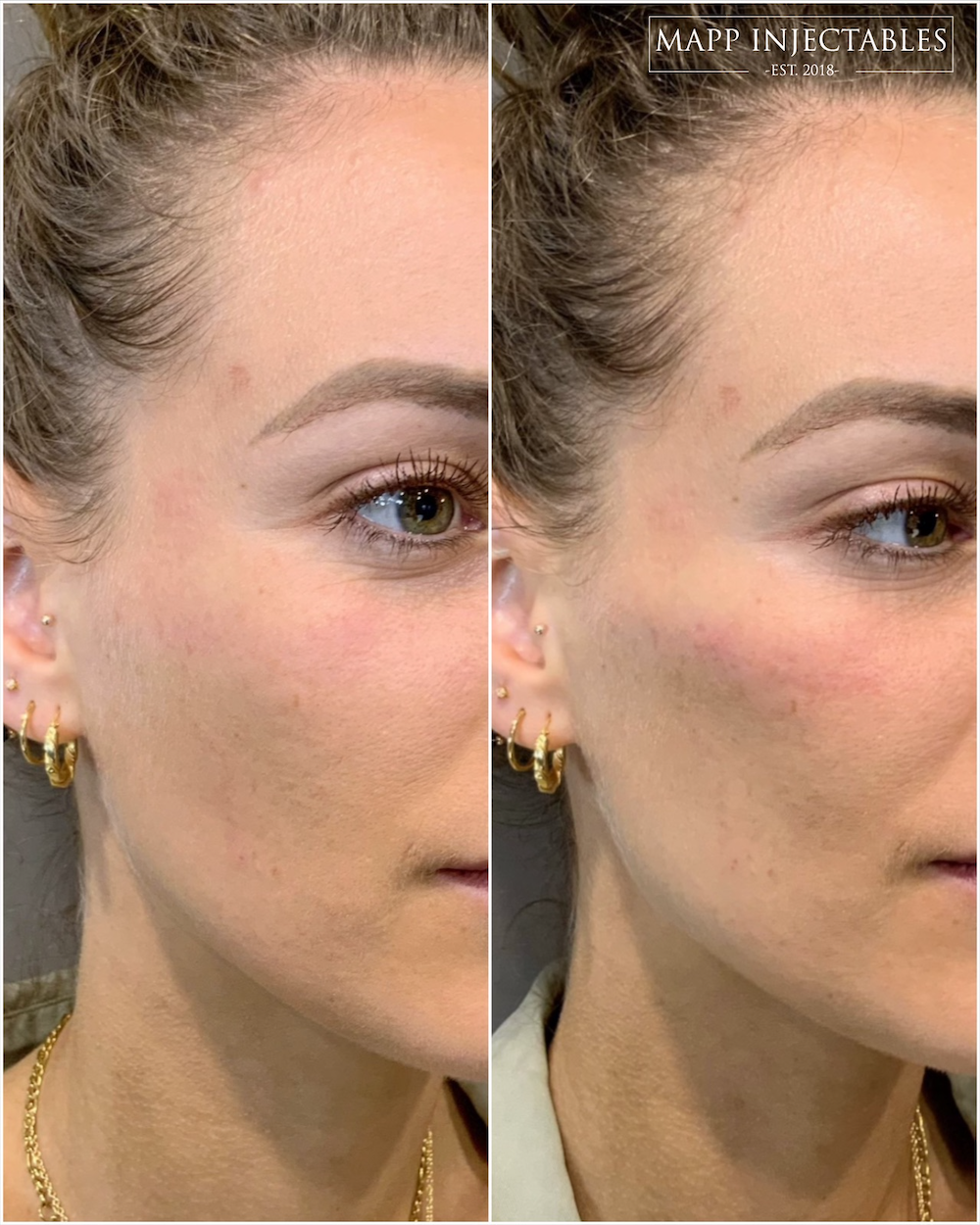 Subtle Cheek Fillers Before After I Didnt Know It Could Do This - abnq7a0