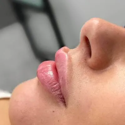 Side angle of Russian lips with top lip lift