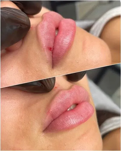 Perfect lip shape and volume using 1ml of lip filler