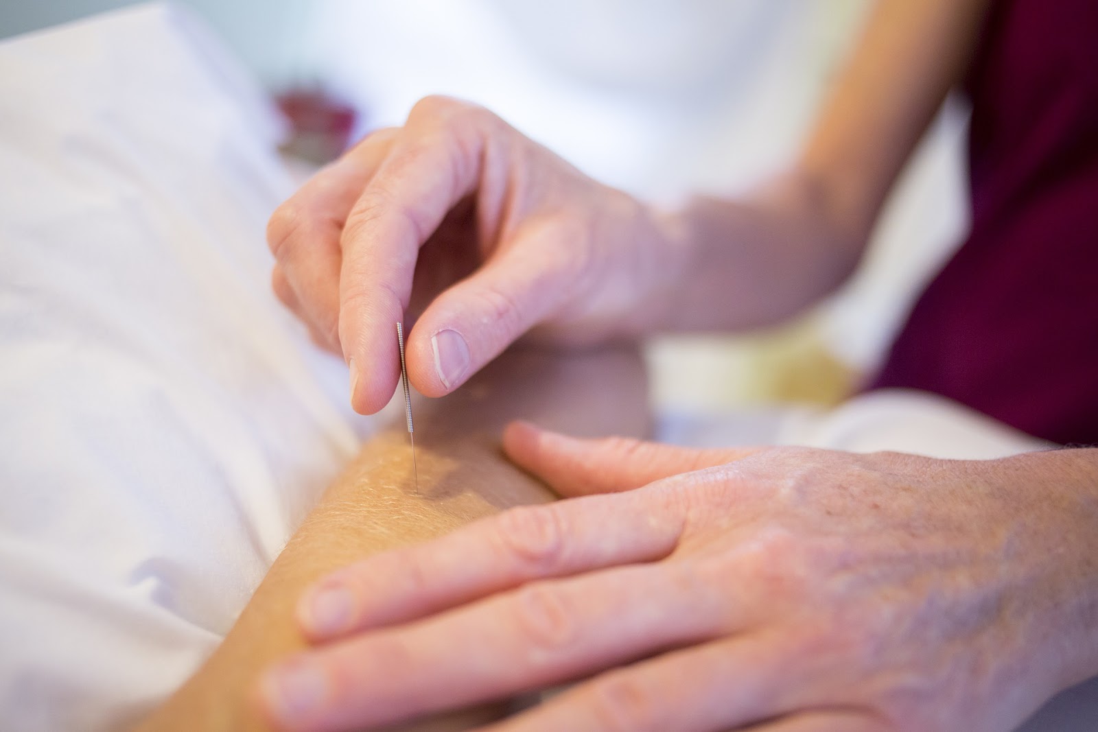 Person performing acupuncture in client's arm