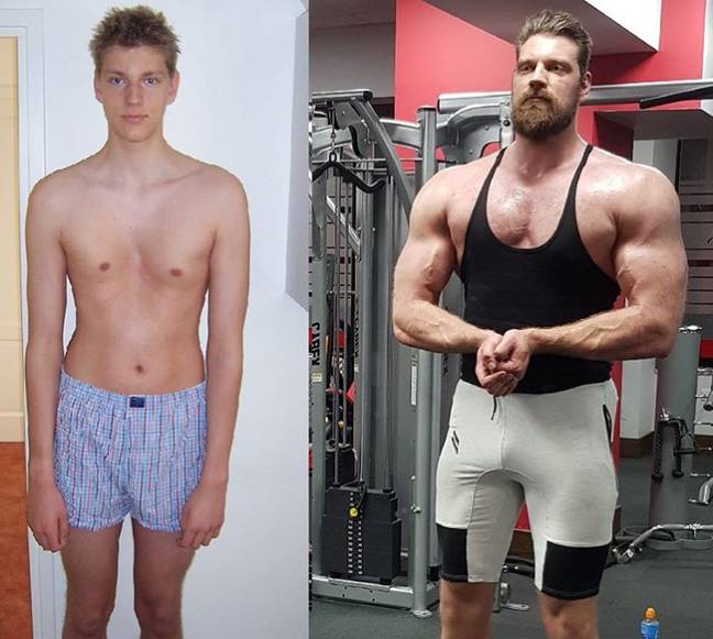 oliver richters before and after pectus surgury