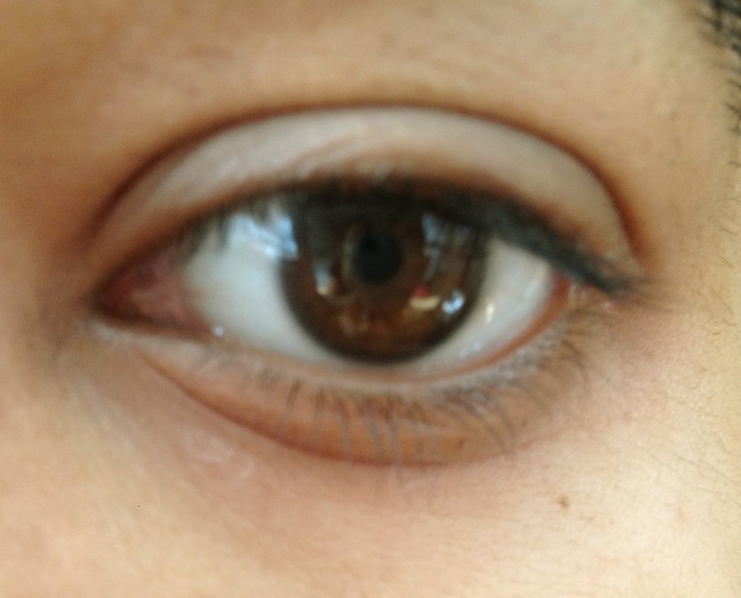 dry skin around eyes pictures