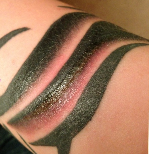 infected tattoo