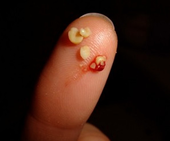 tonsilloliths pictures
