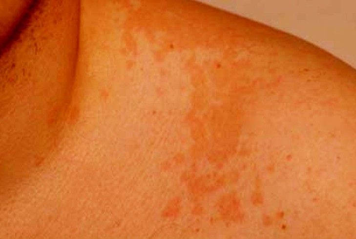pityriasis versicolor pictures 2