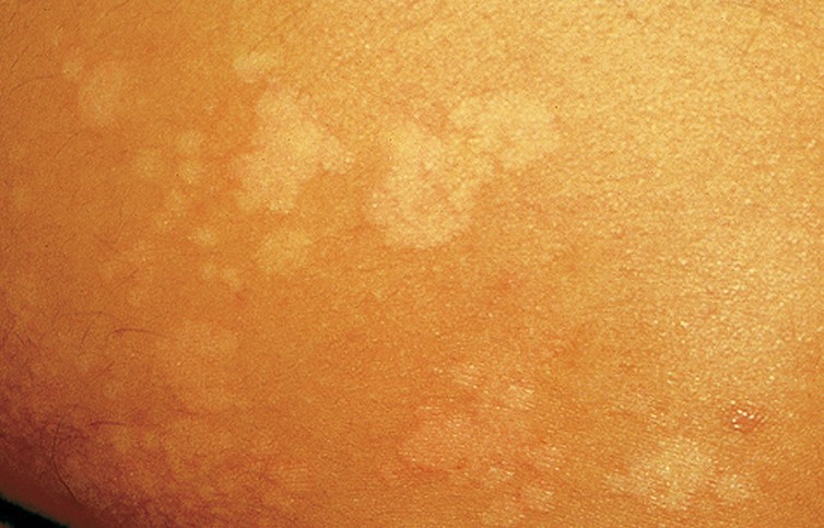 pityriasis versicolor pictures
