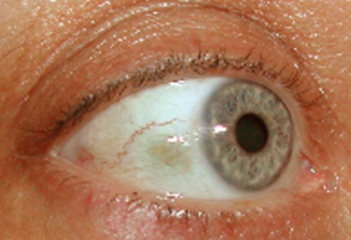 bump on eyeball pictures 2