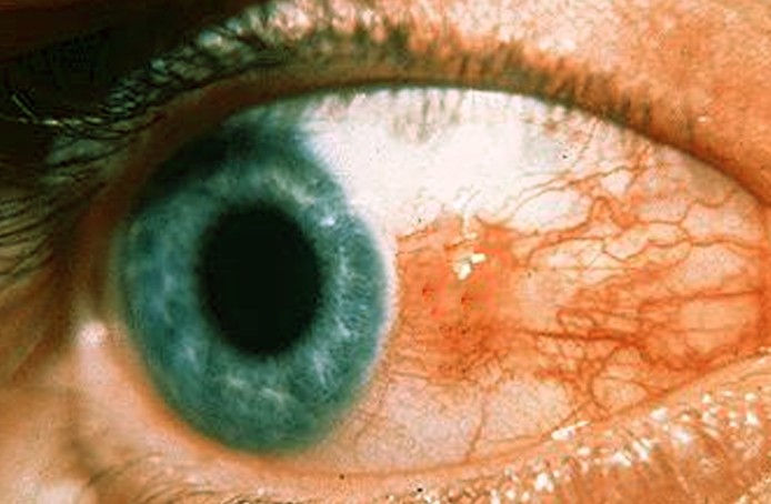 bump on eyeball pictures