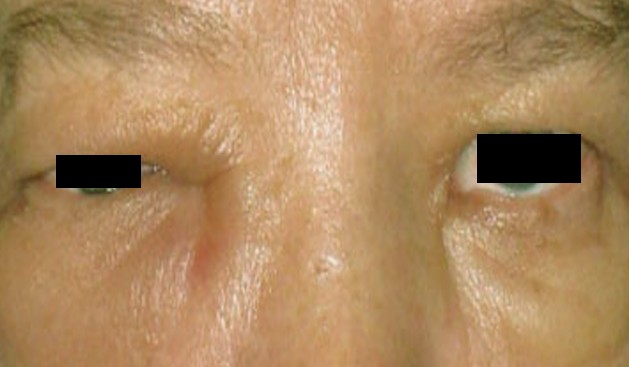 periorbital edema pictures 2