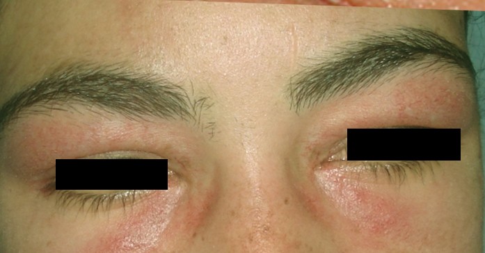 periorbital edema