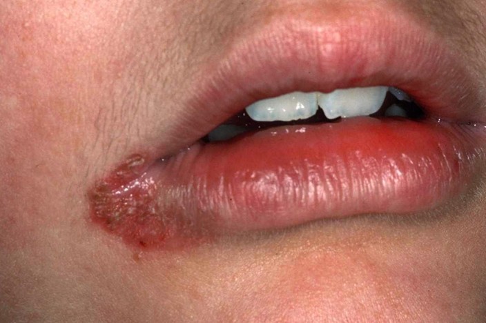 cheilosis
