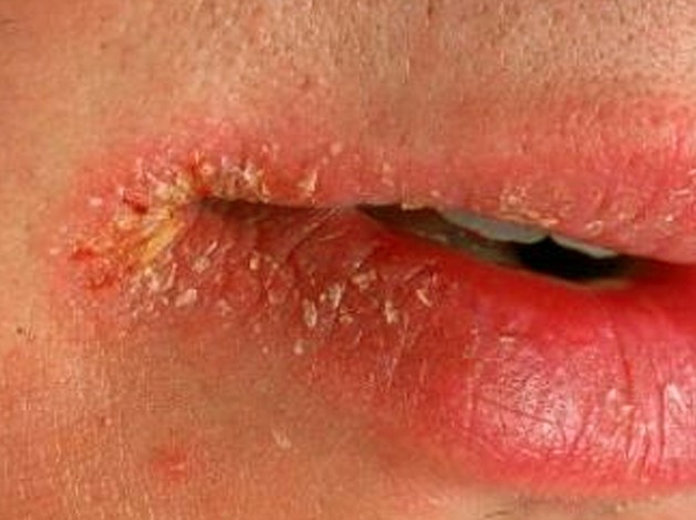 cheilosis pictures 2