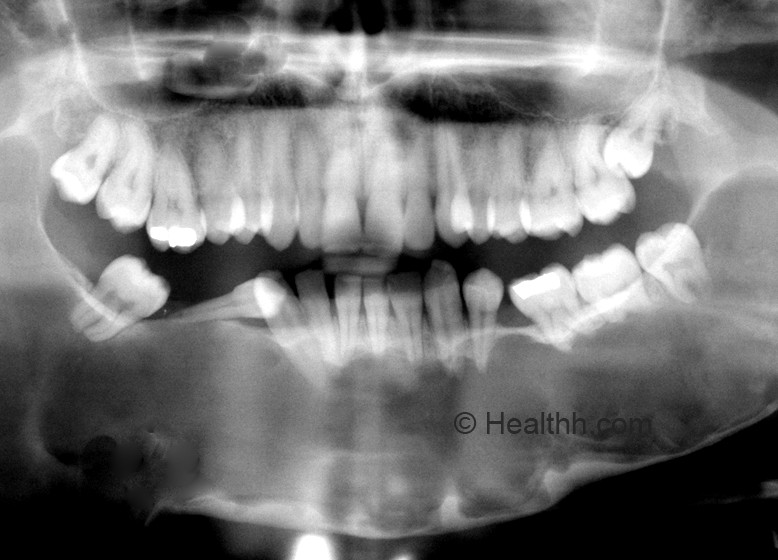 odontogenic keratocyst