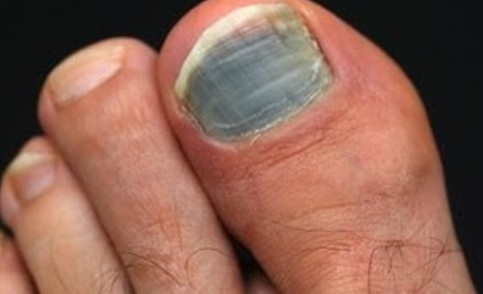 black toenail