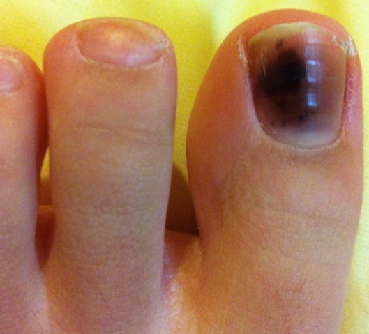 black toenail pictures 3