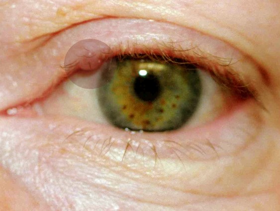cyst on eyelid pictures 4