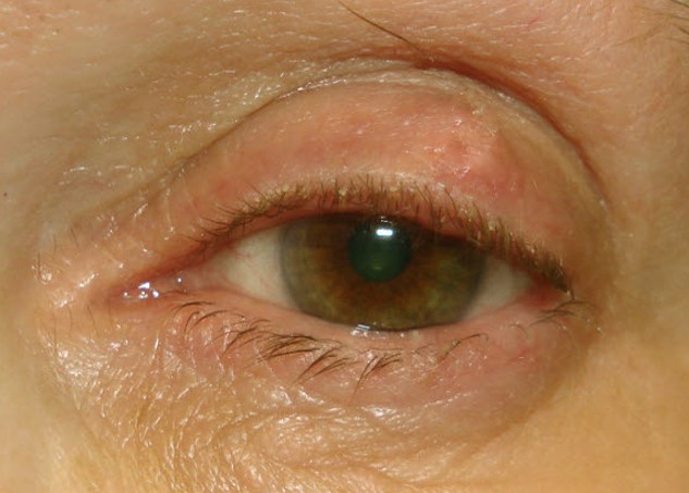 cyst on eyelid