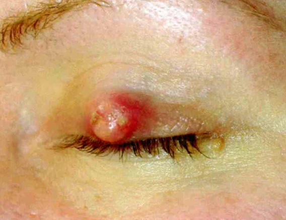 cyst on eyelid pictures