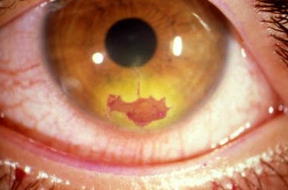 herpes keratitis pictures