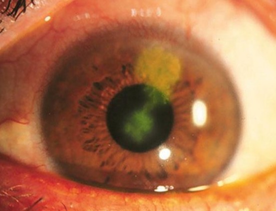 herpes keratitis