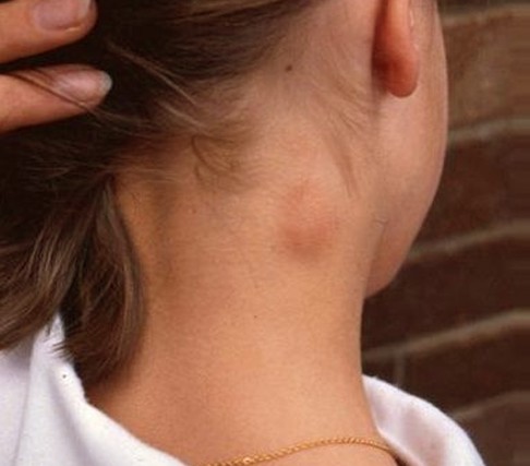 lump on side of neck