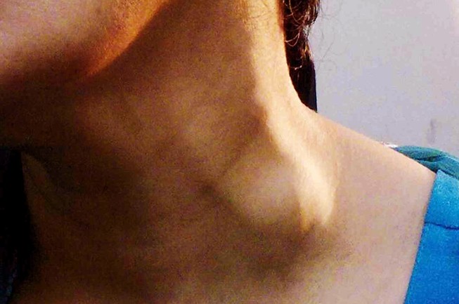 lump on side of neck pictures 2
