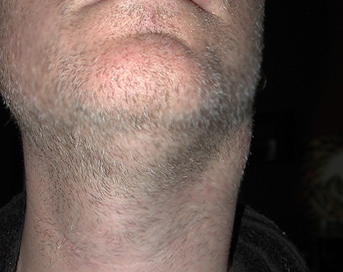 lump on side of neck pictures