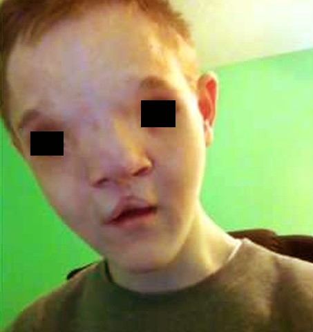 craniodiaphyseal dysplasia 2