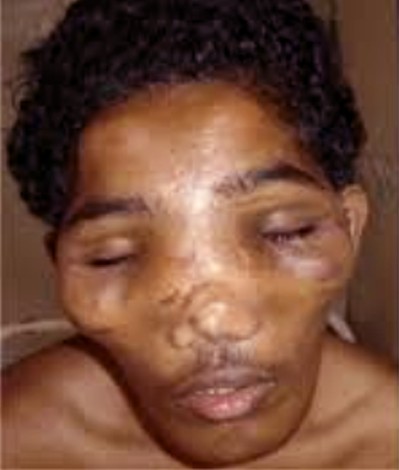 craniodiaphyseal dysplasia