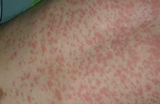 maculopapular rash images