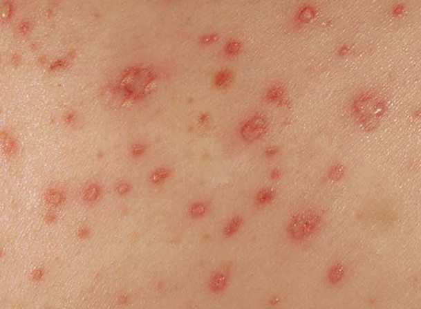 maculopapular rash pics