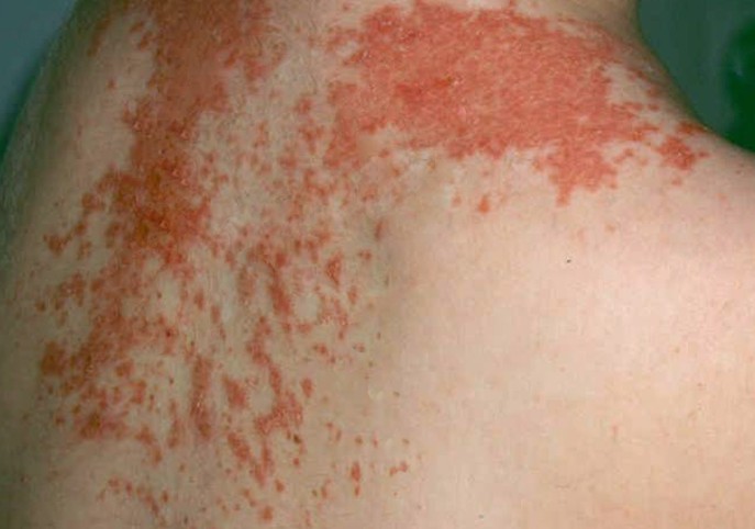 maculopapular rash photos