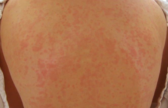 maculopapular rash