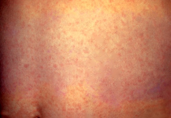 maculopapular rash pictures