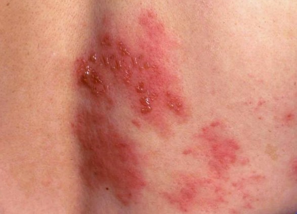 shingles pictures
