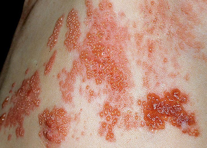 shingles