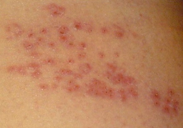 shingles photos