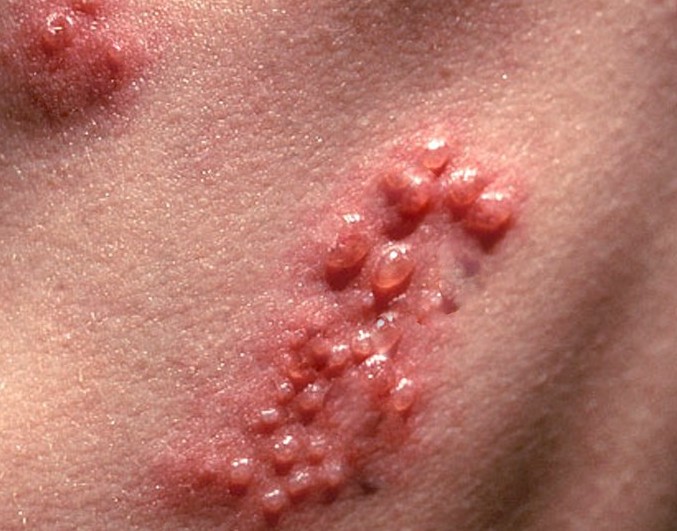 shingles pictures 2