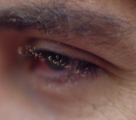 burnt eyelashes
