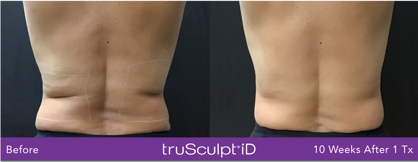 body sculpting austin tx