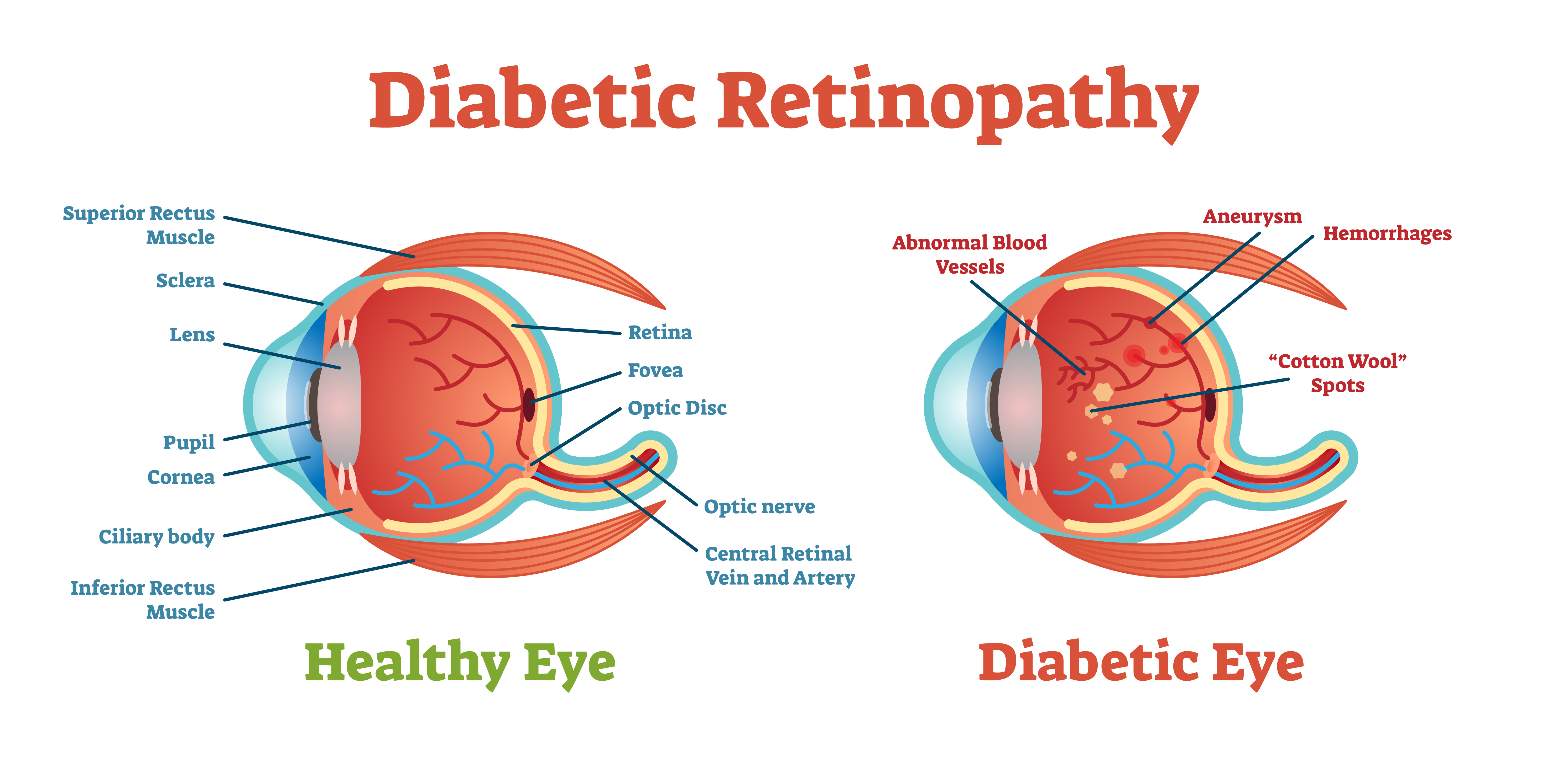 What is Diabetic Eye Disease?