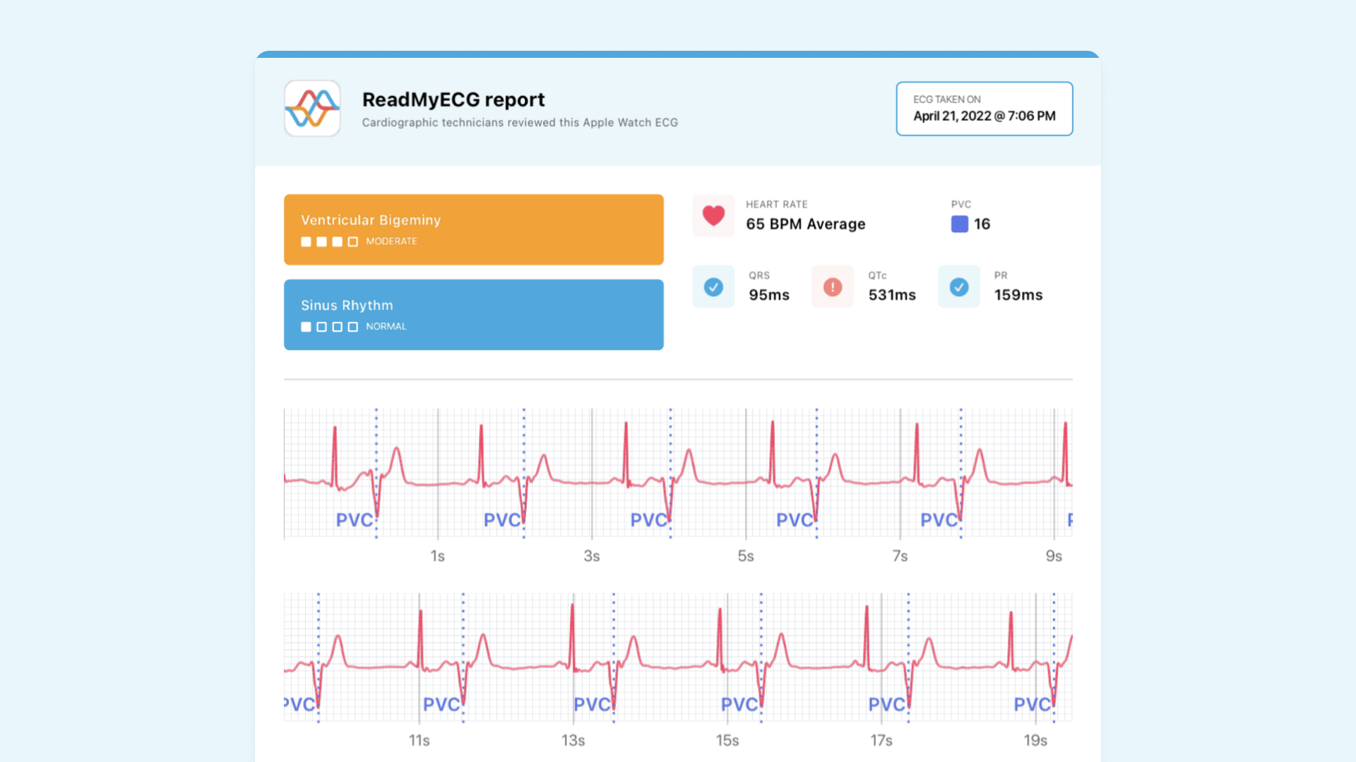 Prolonged QTC with smartwatch Apple Watch ECG