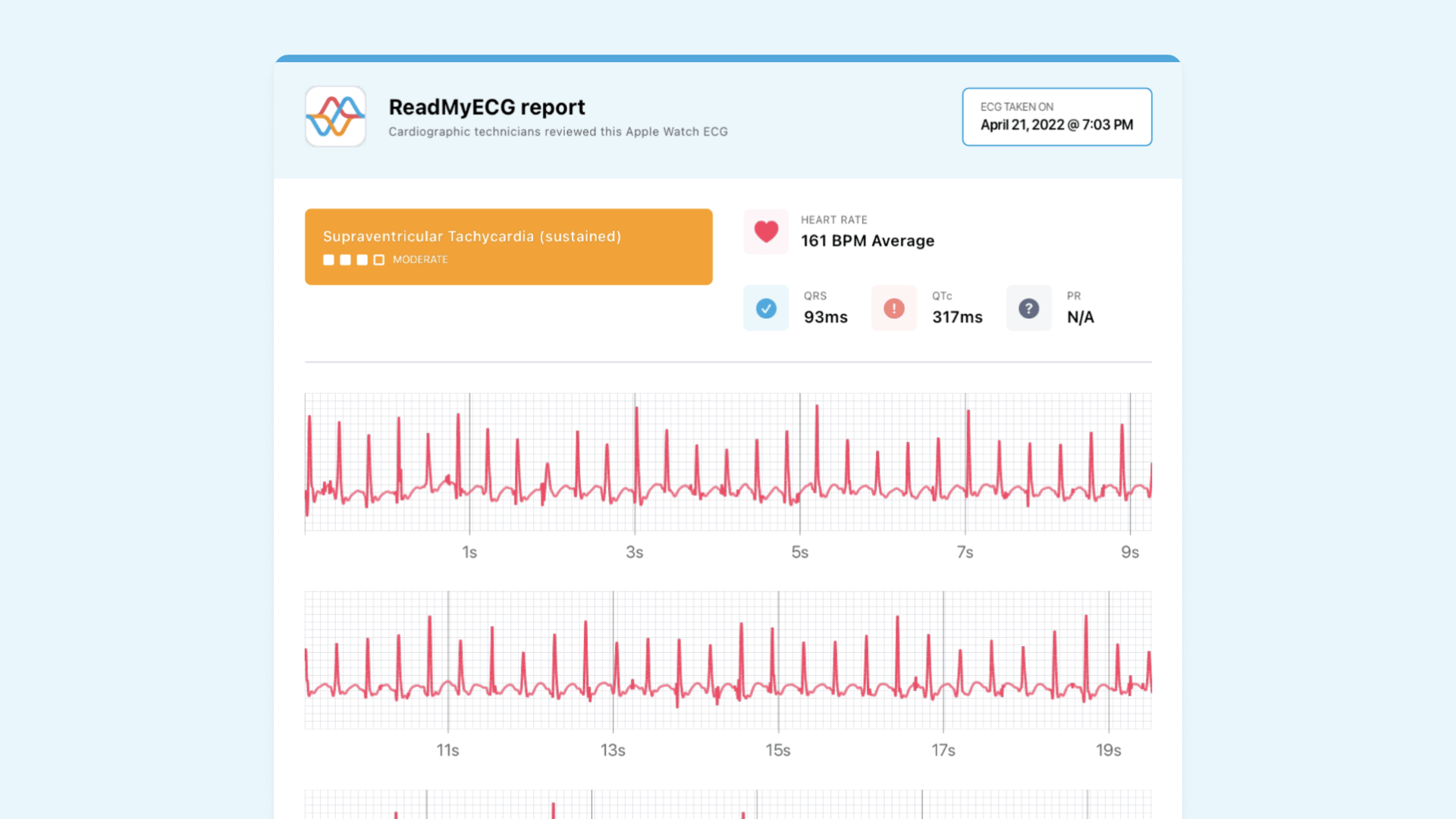 Short QTC with smartwatch Apple Watch ECG