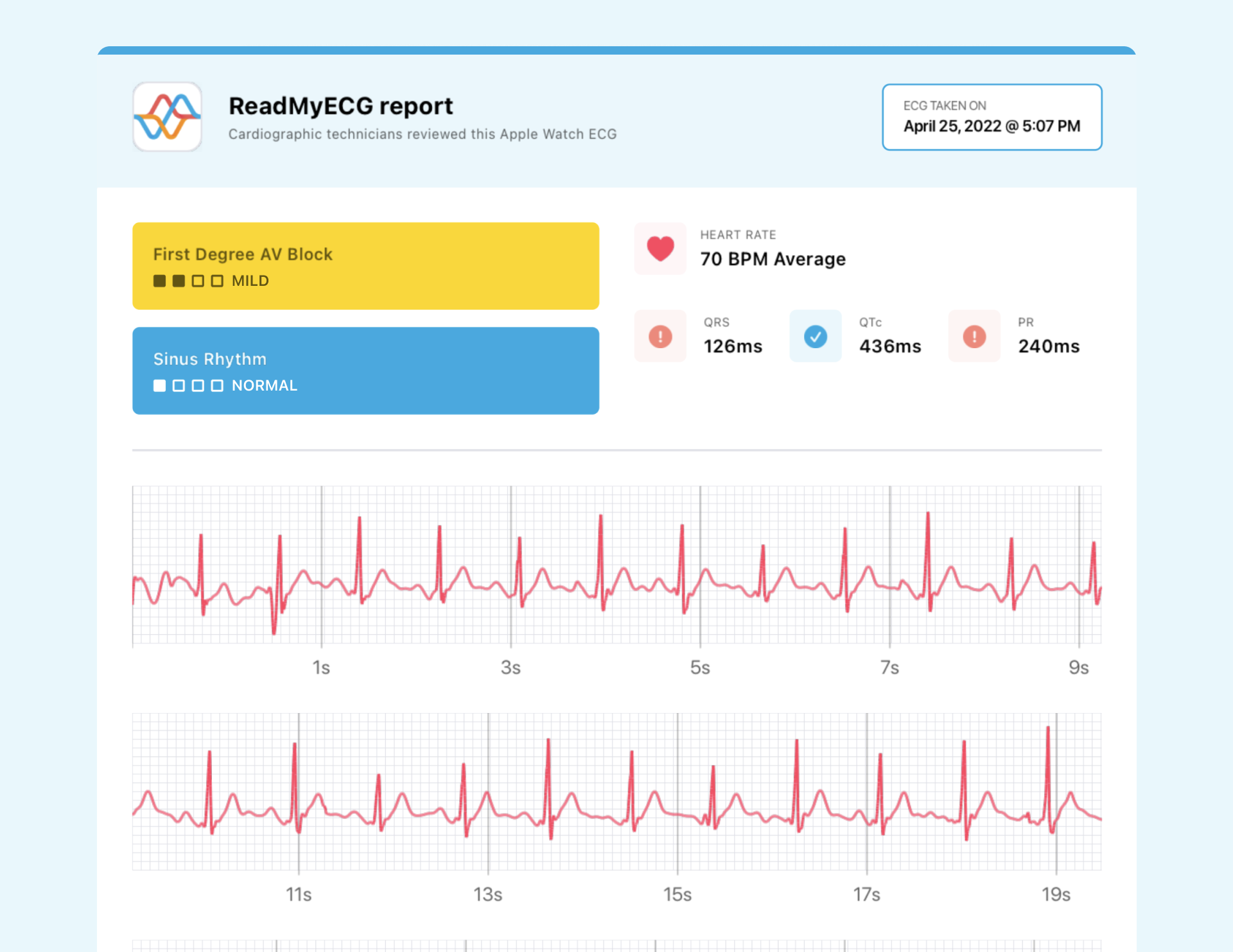 Apple Watch ECG showing a prolonged PR interval - ReadMyECG interpretation
