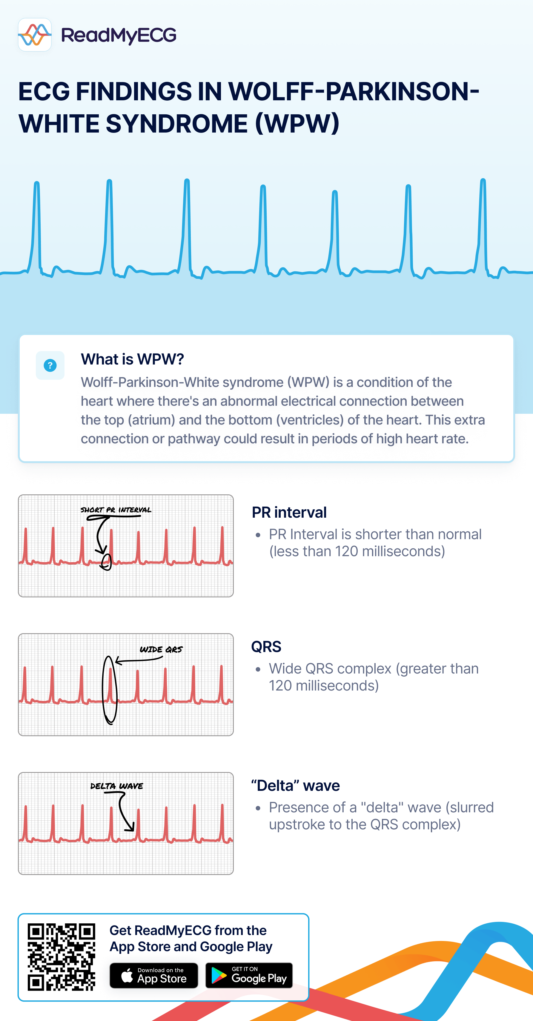 ECG Findings in wolff-parkinson-white syndrome (WPW) in ECG