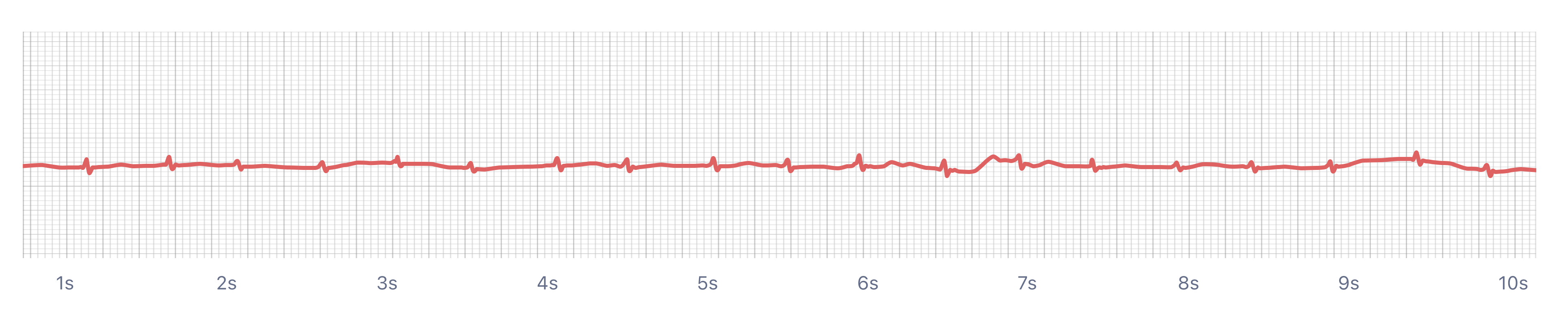 Atrial Fibrillation episode on smartwatch ECG (Kardia, Apple Watch, Samsung, Fitbit)