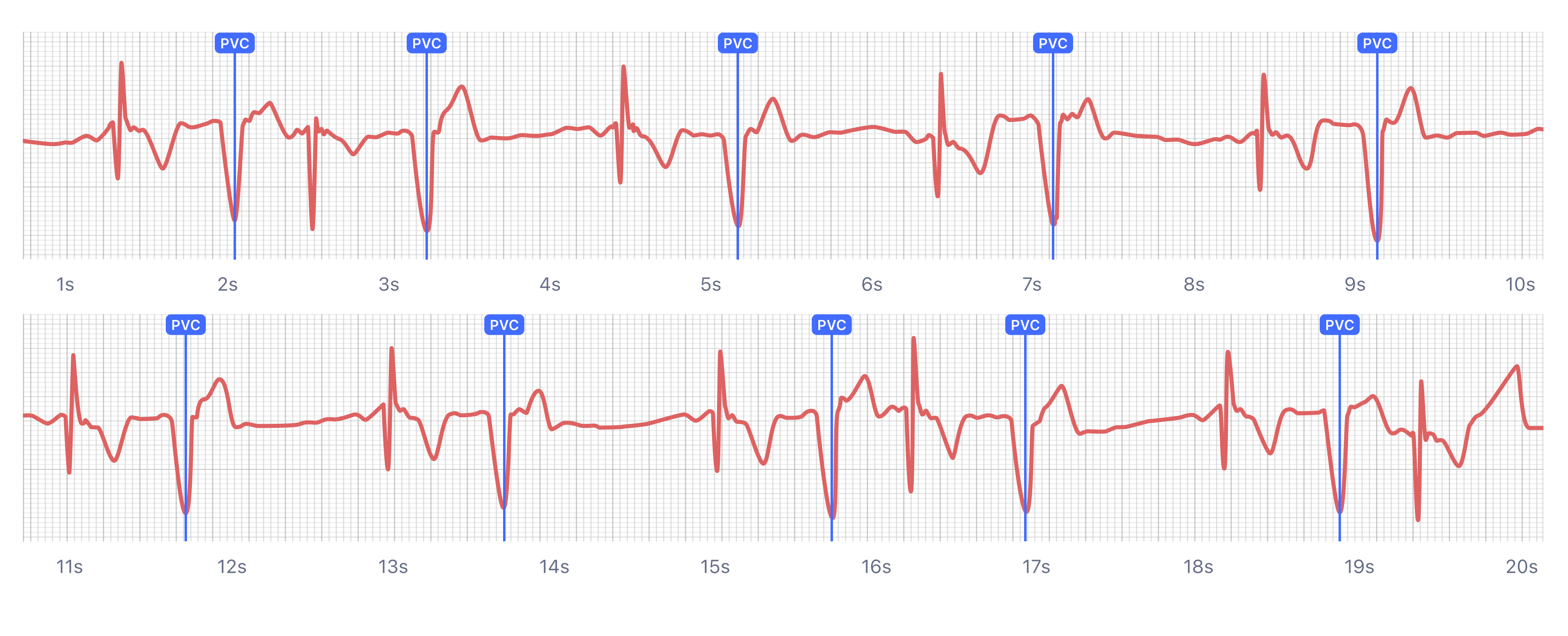 Ventricular Bigeminy on smartwatch ECG (Apple Watch, Kardia, Samsung, Fitbit)