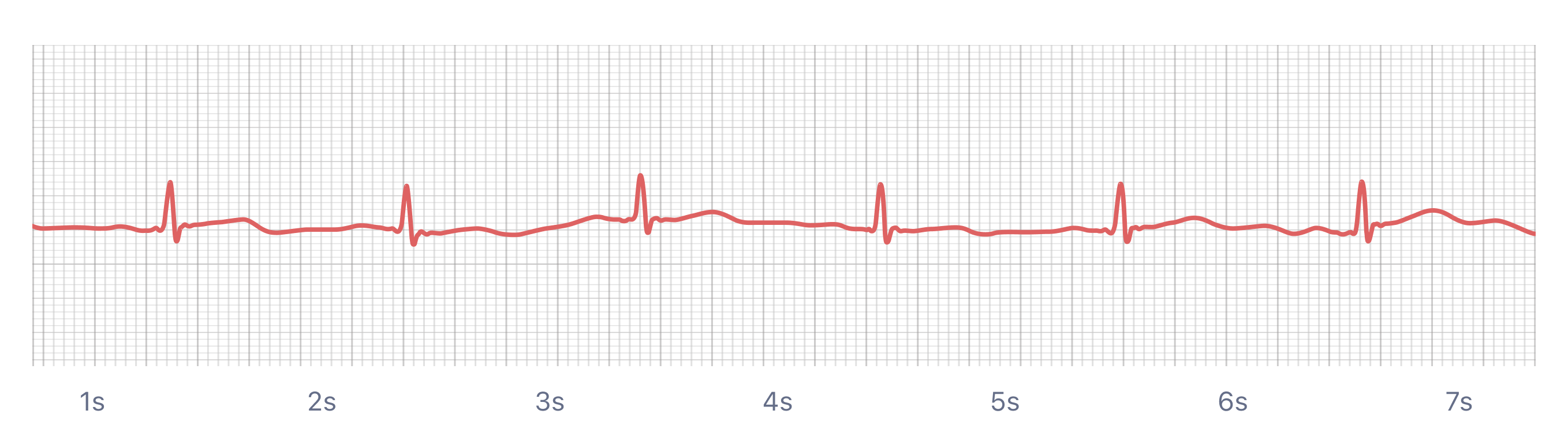 Sinus Rhythm on smartwatch ECG (Apple Watch, Kardia, Samsung, Fitbit)