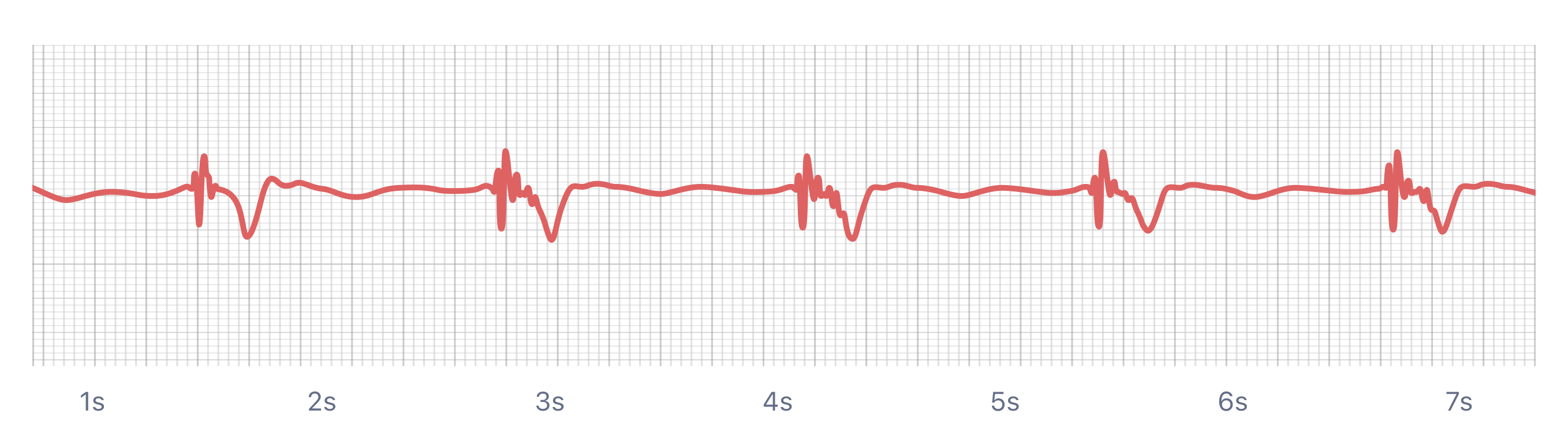 Paced Rhythm on smartwatch ECG (Apple Watch, Kardia, Samsung, Fitbit)